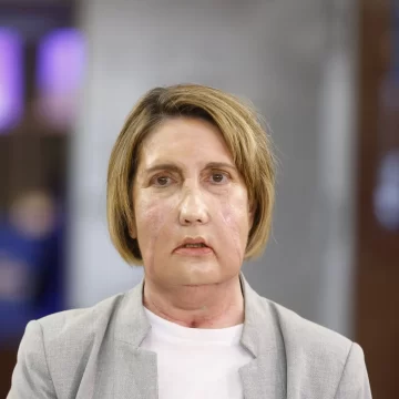 Hospital de Barcelona realiza el primer trasplante parcial de cara con donante que recibió eutanasia